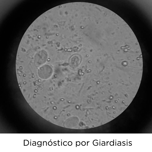 giardiasis